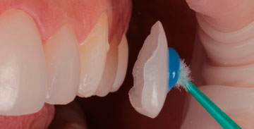 Dr. Rafael Pocztaruk Lentes de Contato Dental Porto Alegre