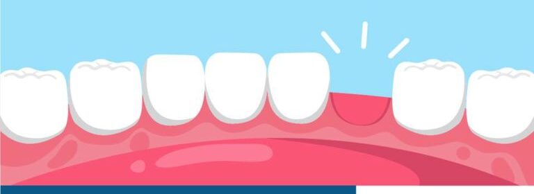 Dr. Rafael Pocztaruk perda de um dente Dr. Rafael Pocztaruk perda de um dente