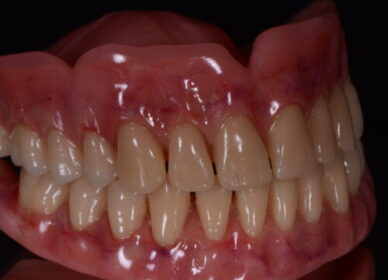 Dentadura-porto-alegre-500x500 Dentadura-porto-alegre-500x500