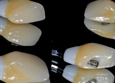 implantes-500x432 implantes-500x432